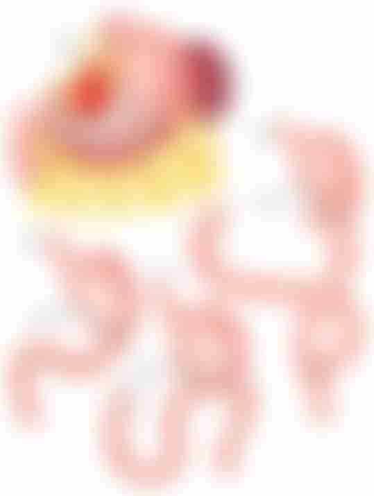 Partial Gastrectomy